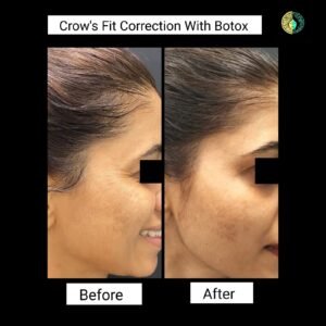 Crows_fit_correction_with_botox_dermatrix_mumbai