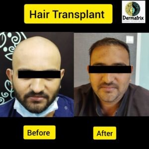 dermatrix_after_before_pic_hair_treatment